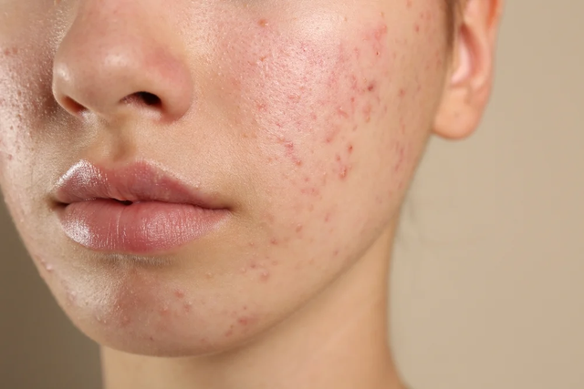 Trioderma Intensive Acne Spot Gel Wins Praise as Fast‑Acting, Multi‑Target Acne Treatment